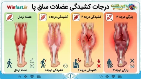 درجات کشیدگی عضله ساق پا